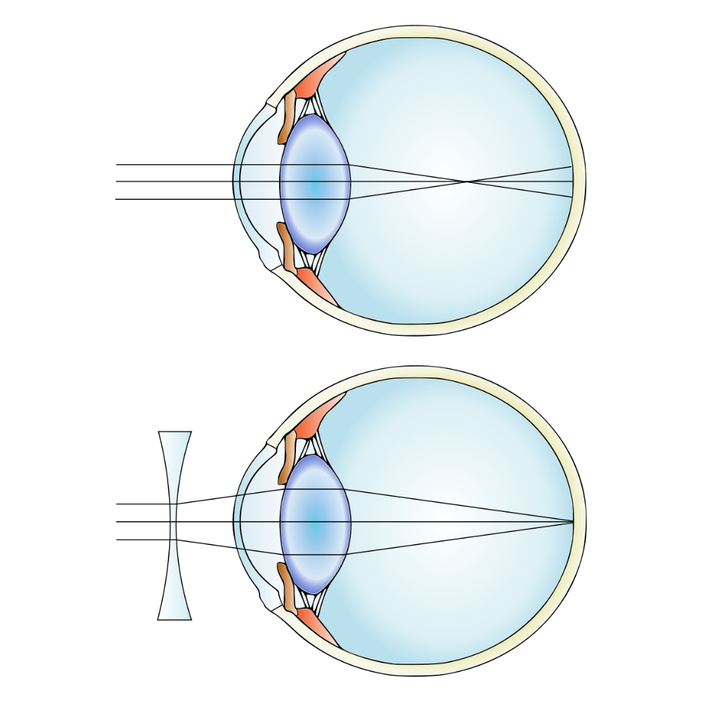 Diagrama que explica el control de la miopía con una lente cóncava.