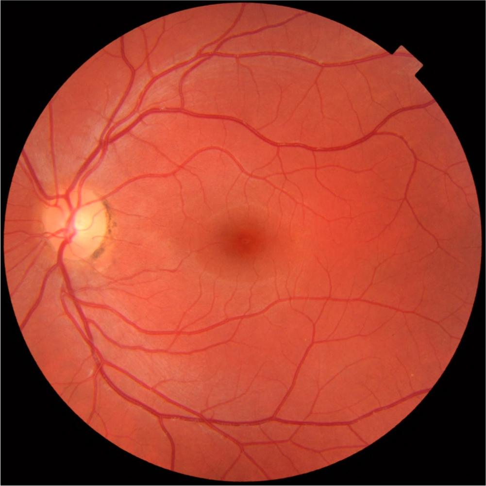 Imagen de una retinografía digital del fondo de ojo para un examen de salud ocular.